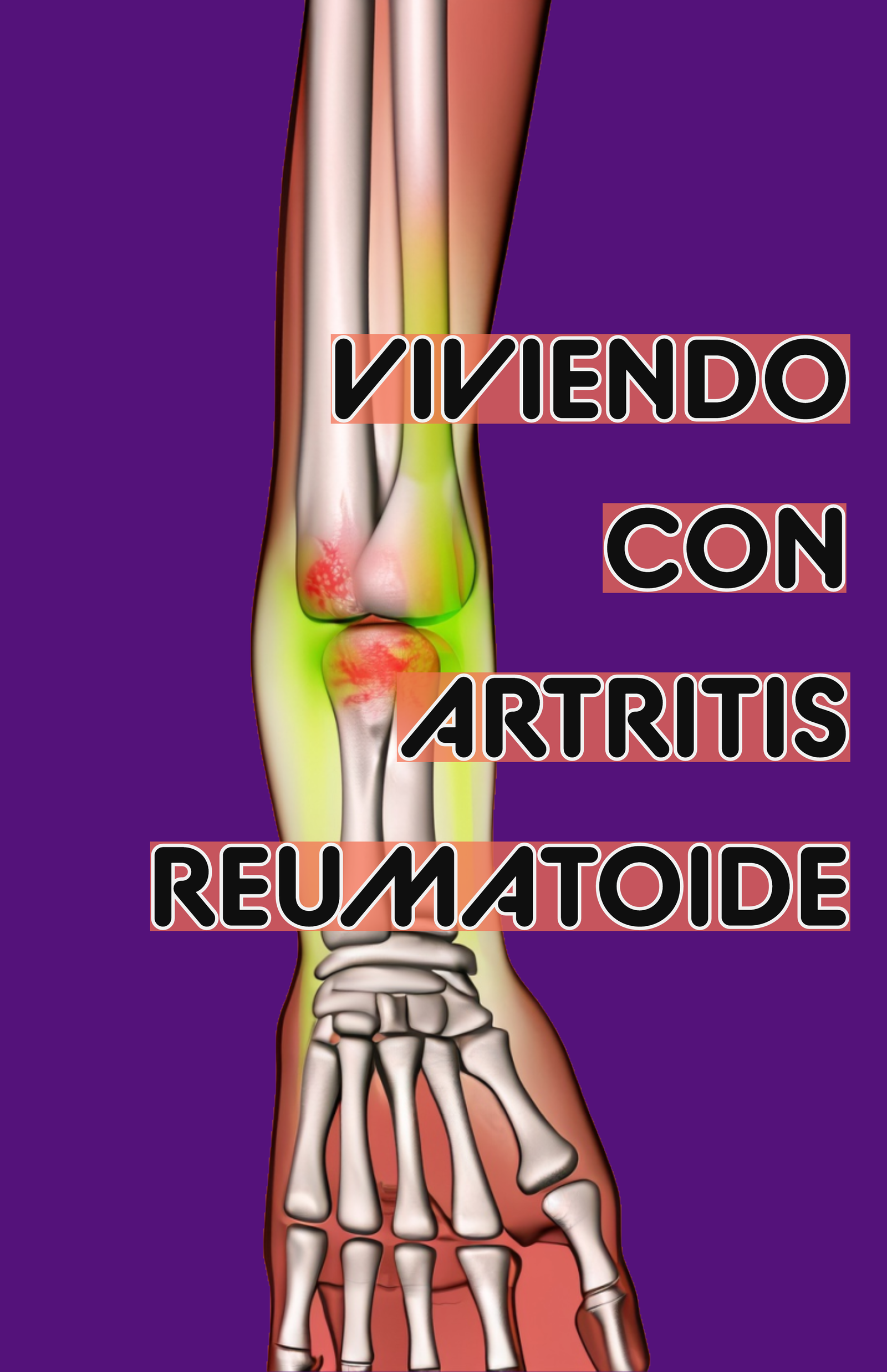 Artritis Reumatoide